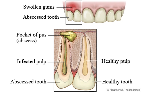 Natural treatment of Abscess