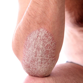 Natural treatment of Psoriasis