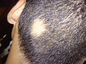 Fast Natural Permanent treatment of Alopecia